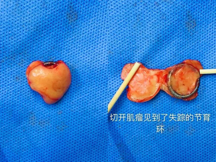 宫内节育器y型,渭北宫内节育器