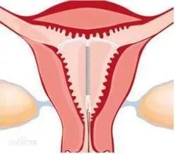 宫内节育器y型,渭北宫内节育器