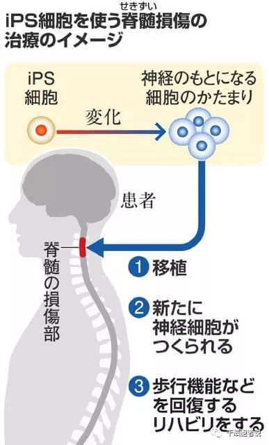 日本干细胞治疗脑卒中病人,日本干细胞治疗脊髓损伤的进展