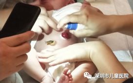 造口宝宝,造口宝宝的饮食注意事项