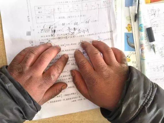 冬天脚长冻疮晚上就痒,冬天脚冻疮了疼痒怎么办