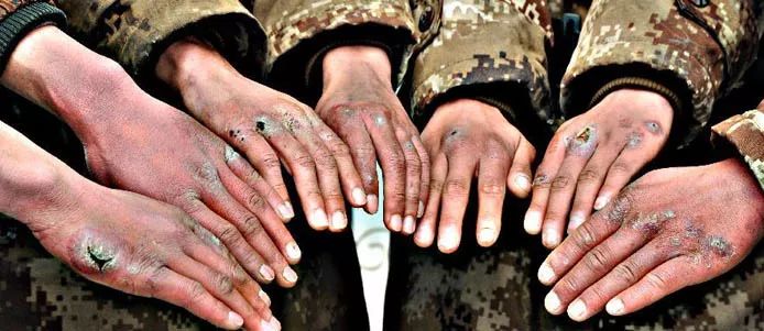 冬天脚长冻疮晚上就痒,冬天脚冻疮了疼痒怎么办