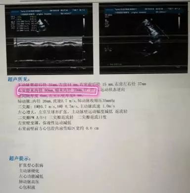 心肌缺血引起心衰能治愈吗,根治心肌缺血的中成药心可舒
