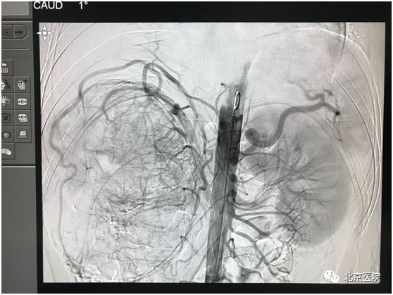 肿瘤肾癌微创手术费用,医大二院肾癌微创手术