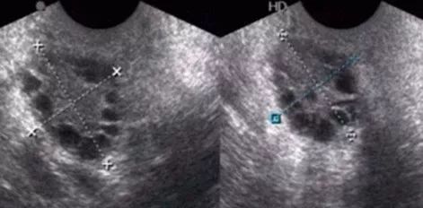 卵巢功能减退可以怀孕吗,卵巢储备功能下降会怀孕吗