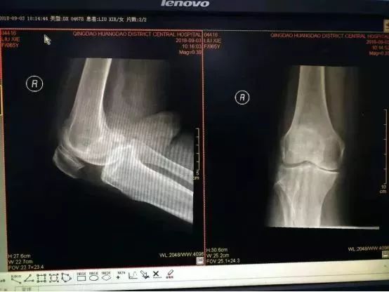 膝关节置换是微创还是开刀,膝关节置换必须要用助行器吗