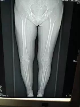 膝关节置换是微创还是开刀,膝关节置换必须要用助行器吗