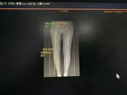 膝关节置换是微创还是开刀,膝关节置换必须要用助行器吗