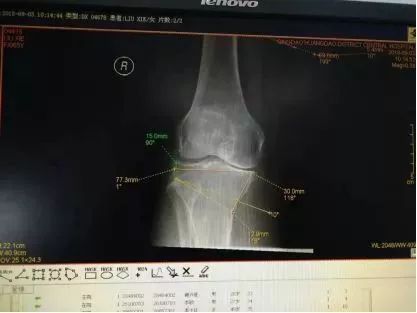 膝关节置换是微创还是开刀,膝关节置换必须要用助行器吗