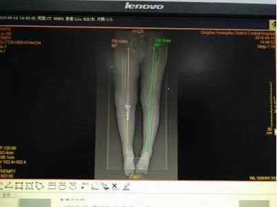 膝关节置换是微创还是开刀,膝关节置换必须要用助行器吗