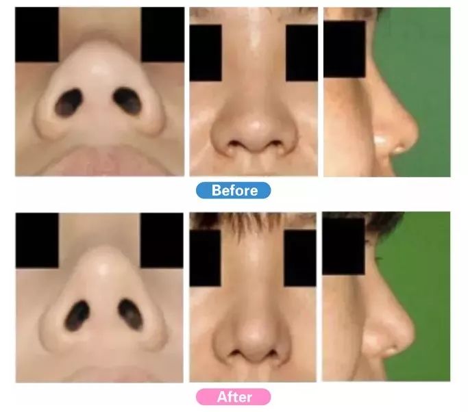 强势围观!日本最牛的一家整形医院,募集中国模特啦啦啦~