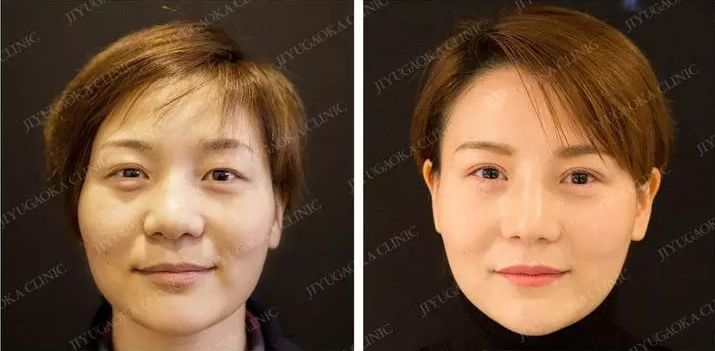 强势围观!日本最牛的一家整形医院,募集中国模特啦啦啦~