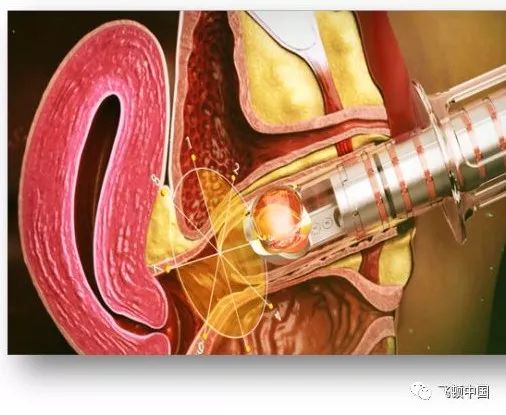 产后修复话题,产后盆底肌修复正规医院要多少钱