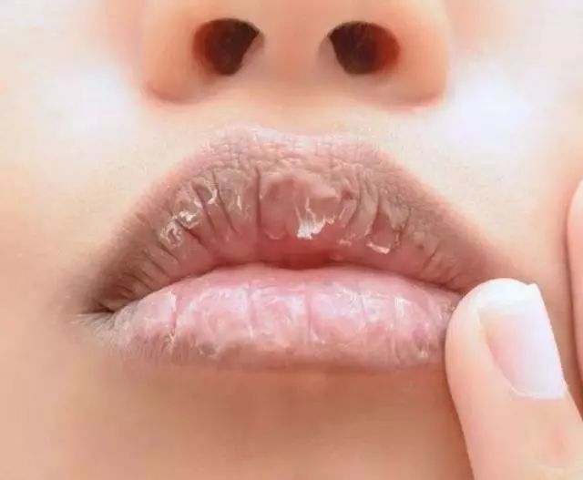 冬天怎样防嘴唇开裂,冬天嘴唇很干燥而且还开裂怎么办