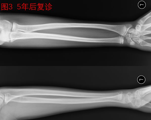 孩子胳膊骨折伸不直康复训练,小孩胳膊骨折需要做康复训练吗