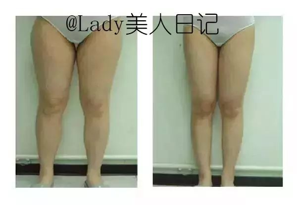 一周瘦腿方法筷子腿小红书,小红书一周内瘦腿方法
