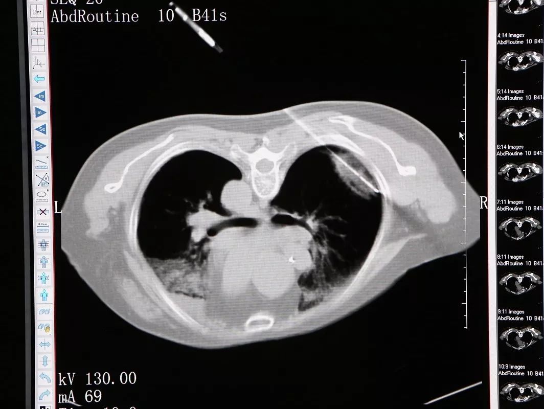 一根消融针能消融多少结节,一根针杀灭癌细胞
