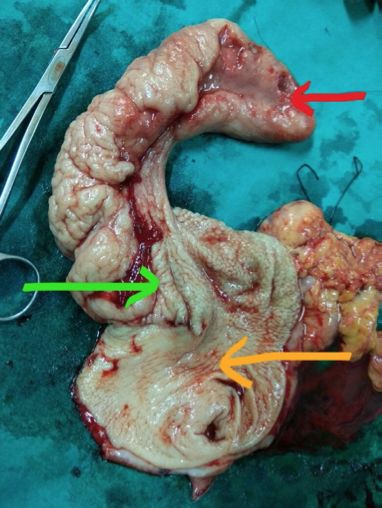 pubmed最新文献如何看全文,pubmed文献推送