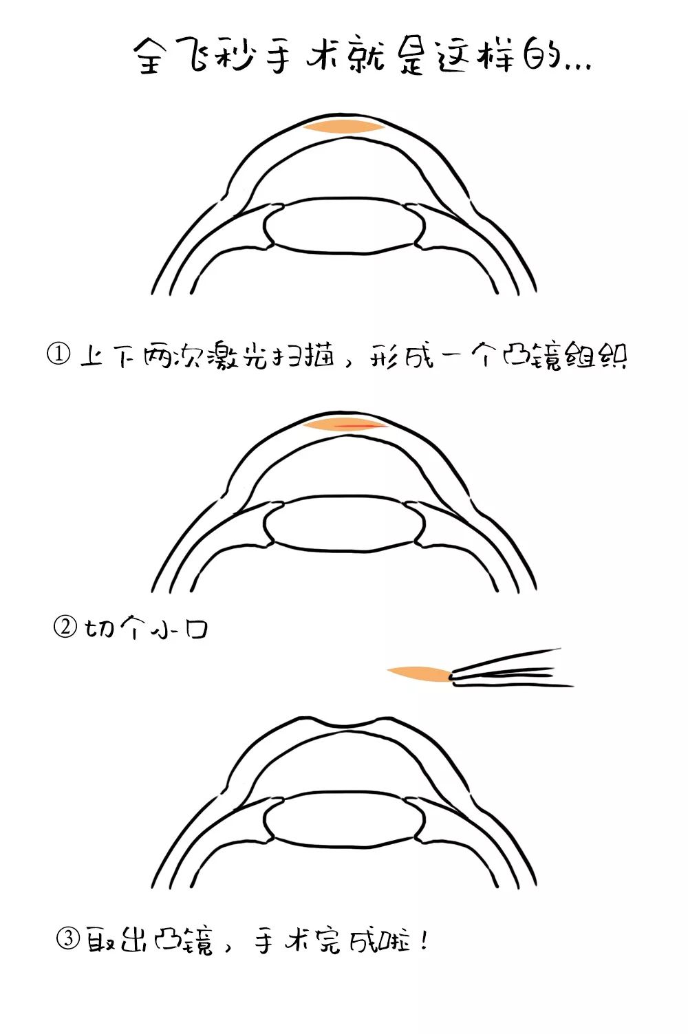 中医眼科治疗近视靠谱吗,手术治近视靠谱吗