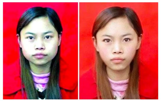 12月4日下午2点直播预告｜“嘴凸被说成猿人”到底该正畸还是做鼻子？