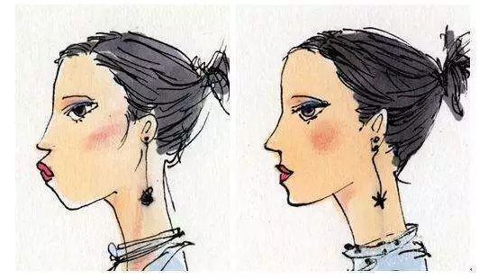 12月4日下午2点直播预告｜“嘴凸被说成猿人”到底该正畸还是做鼻子？