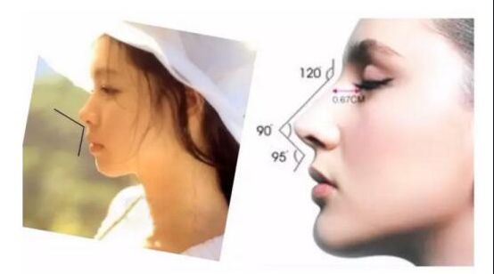 12月4日下午2点直播预告｜“嘴凸被说成猿人”到底该正畸还是做鼻子？