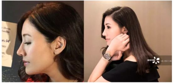 12月4日下午2点直播预告｜“嘴凸被说成猿人”到底该正畸还是做鼻子？