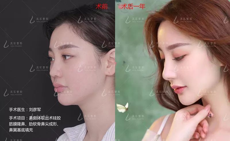 12月4日下午2点直播预告｜“嘴凸被说成猿人”到底该正畸还是做鼻子？