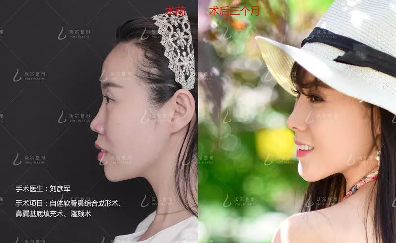 12月4日下午2点直播预告｜“嘴凸被说成猿人”到底该正畸还是做鼻子？