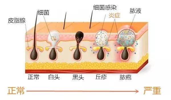 过了青春期长痘痘是什么原因,过了青春期还频繁长痘痘吗