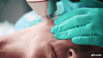 医美微针有什么效果,配合微针做的医美产品有哪些