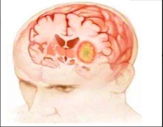 儿童良性癫痫为什么要做基因检测,婴儿癫痫基因治疗