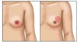 男人左胸部突然变大,男生左侧胸部变大