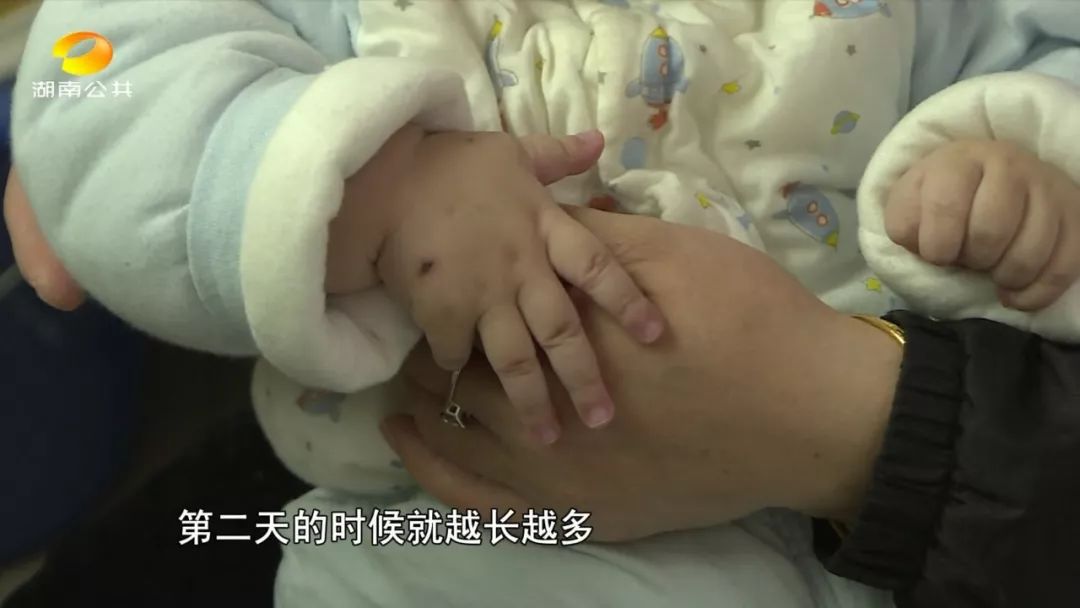 水痘患者家属如何预防,水痘患儿的护理过程及注意事项