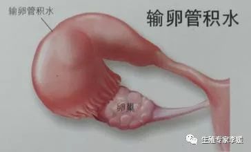 输卵管结扎有什么副作用和危害,输卵管结扎对女性有什么影响吗