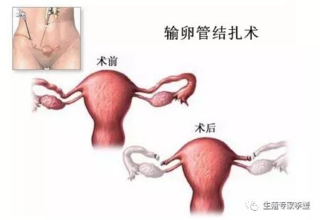 输卵管结扎有什么副作用和危害,输卵管结扎对女性有什么影响吗