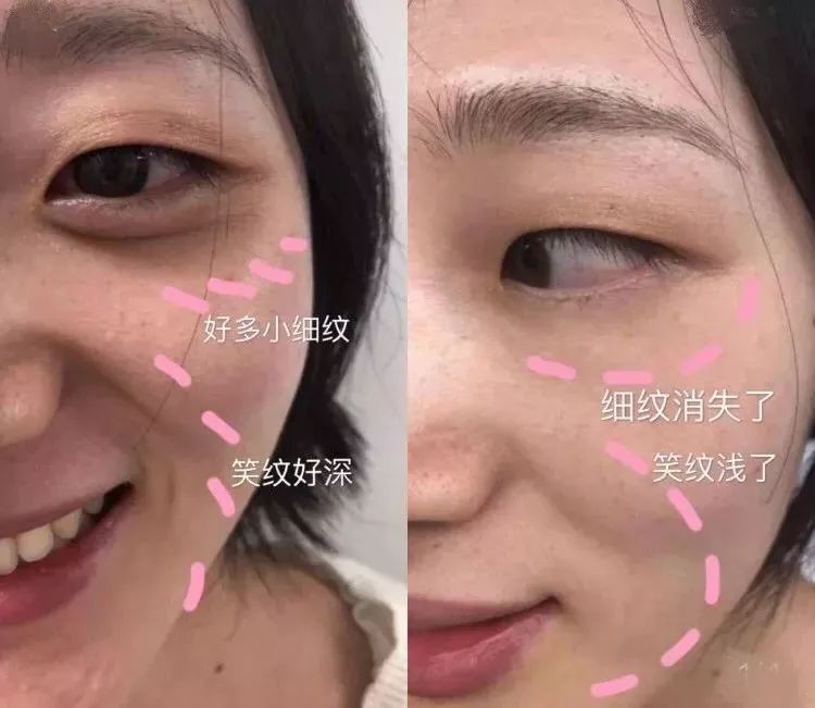 燕窝玻尿酸童颜面膜,玻尿酸燕窝面膜