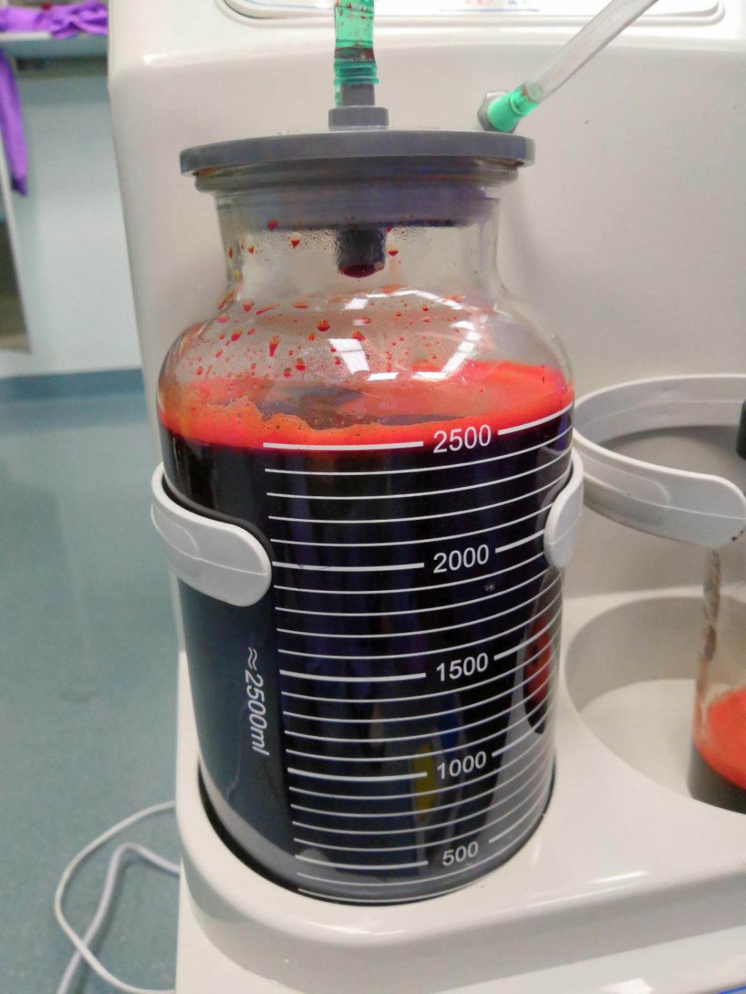 19岁女孩宫外孕误以为阑尾炎,女孩误将宫外孕误诊成阑尾炎