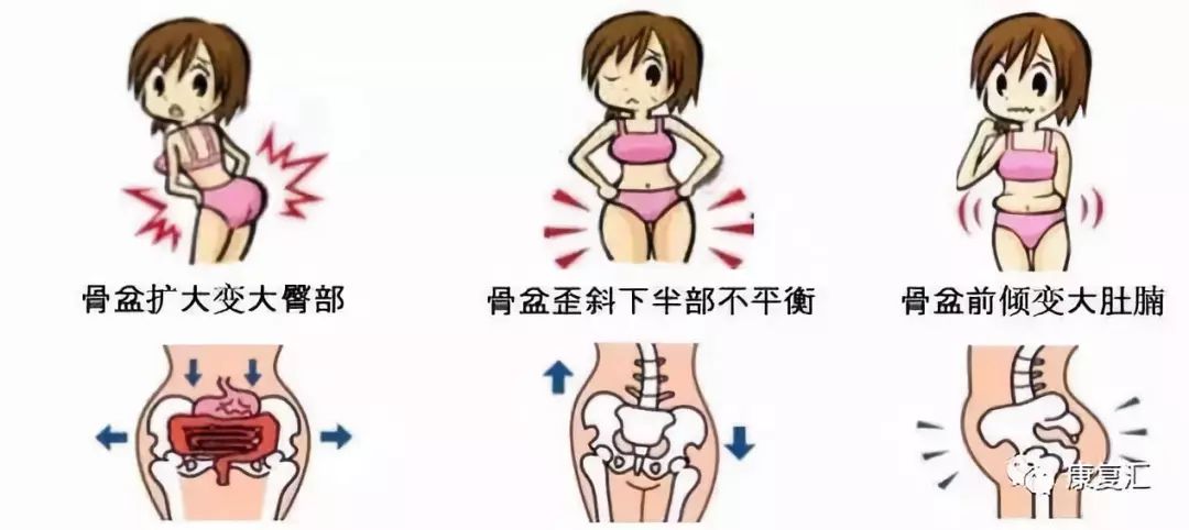 骨盆倾斜能做骨盆修复吗,体态康复骨盆前移