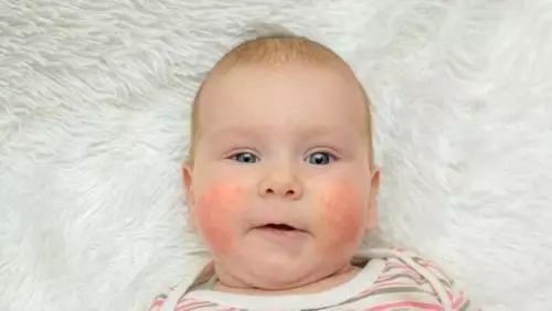 宝宝“湿疹”反复发作治不好？小心是特应性皮炎惹的祸！