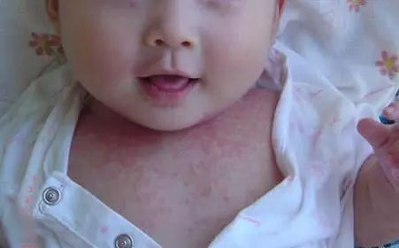 宝宝“湿疹”反复发作治不好？小心是特应性皮炎惹的祸！