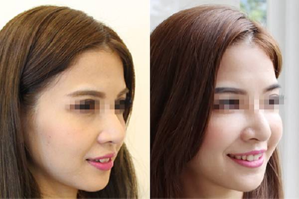 玻尿酸一打就是个无底洞,打玻尿酸现在是不是还挺普遍的