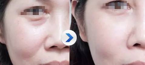 玻尿酸一打就是个无底洞,打玻尿酸现在是不是还挺普遍的