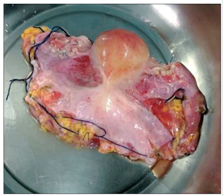柳叶刀人造子宫,柳叶刀移植