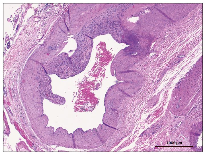 柳叶刀人造子宫,柳叶刀移植