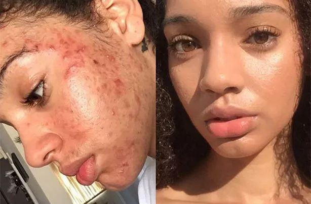 脚气湿疹止痒最快的软膏,湿疹止痒膏可以治脚气吗