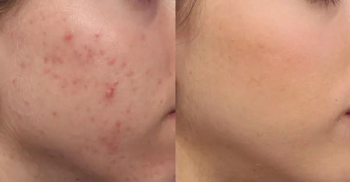 脚气湿疹止痒最快的软膏,湿疹止痒膏可以治脚气吗