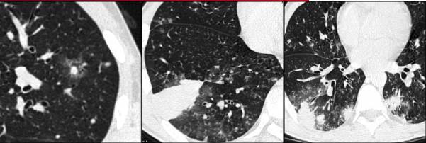 肺实变典型影像,侵入性肺曲霉病和侵袭性肺曲霉病