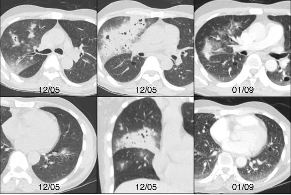 肺实变典型影像,侵入性肺曲霉病和侵袭性肺曲霉病