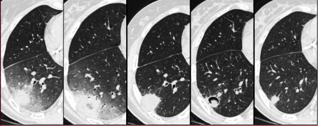 肺实变典型影像,侵入性肺曲霉病和侵袭性肺曲霉病